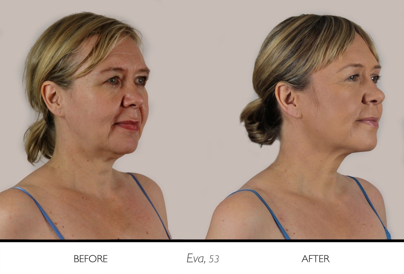 Eva 43 before and after