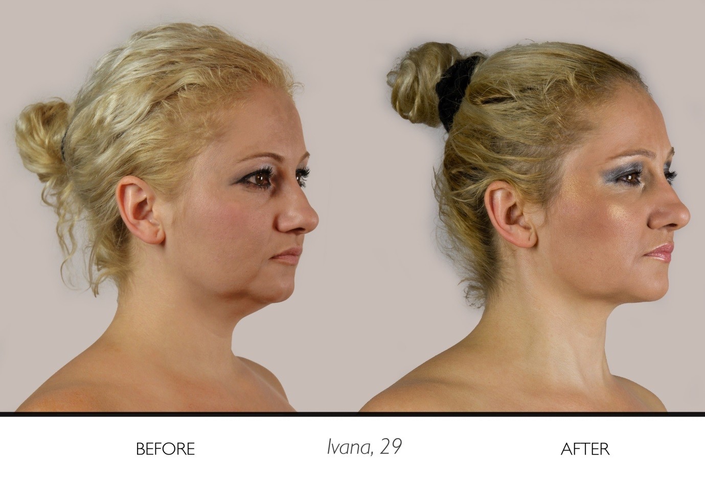 Ivana 29 before and after