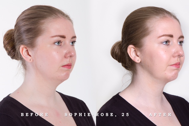 Sophie-rose 25 before and after